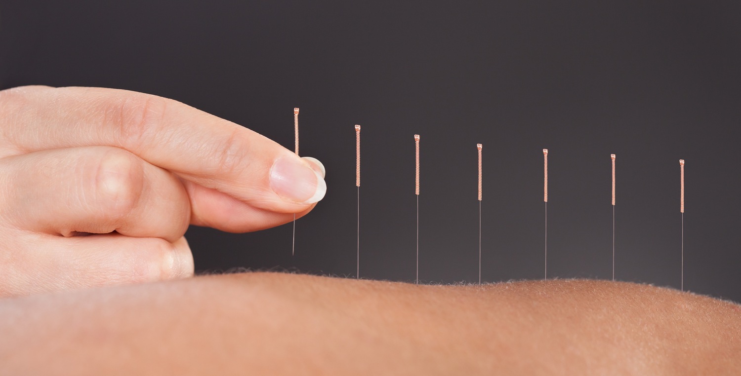 Is Acupuncture a Placebo?