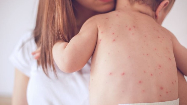 The Resurgence of Measles in the U.S.: Causes, Consequences, and Future Directions